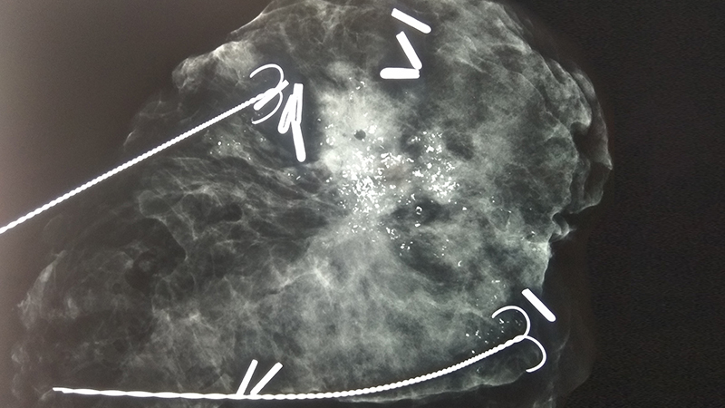 Εικόνα αφαίρεσης αποτιτανώσεων μαστού 1