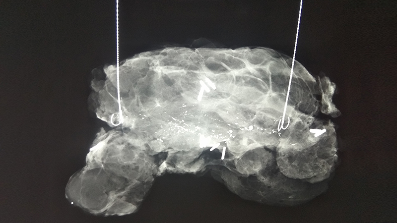 Εικόνα αφαίρεσης αποτιτανώσεων μαστού 2